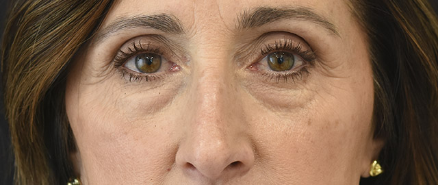 Eyelid Surgery Patient 31 Set 1 Before